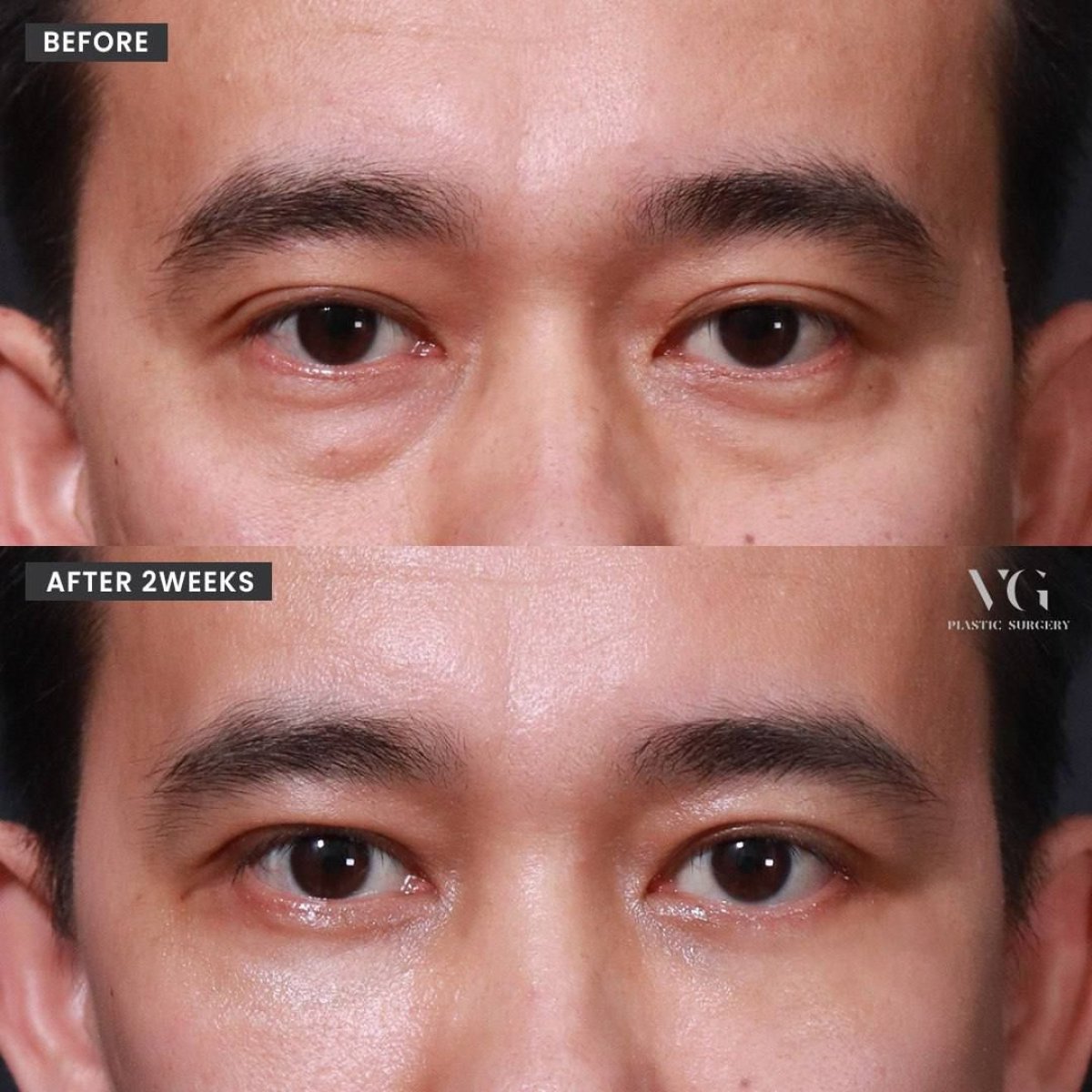 نتائج رأب الجفن السفلي قبل وبعد في VG Plastic Surgery، تقليل انتفاخ تحت العين