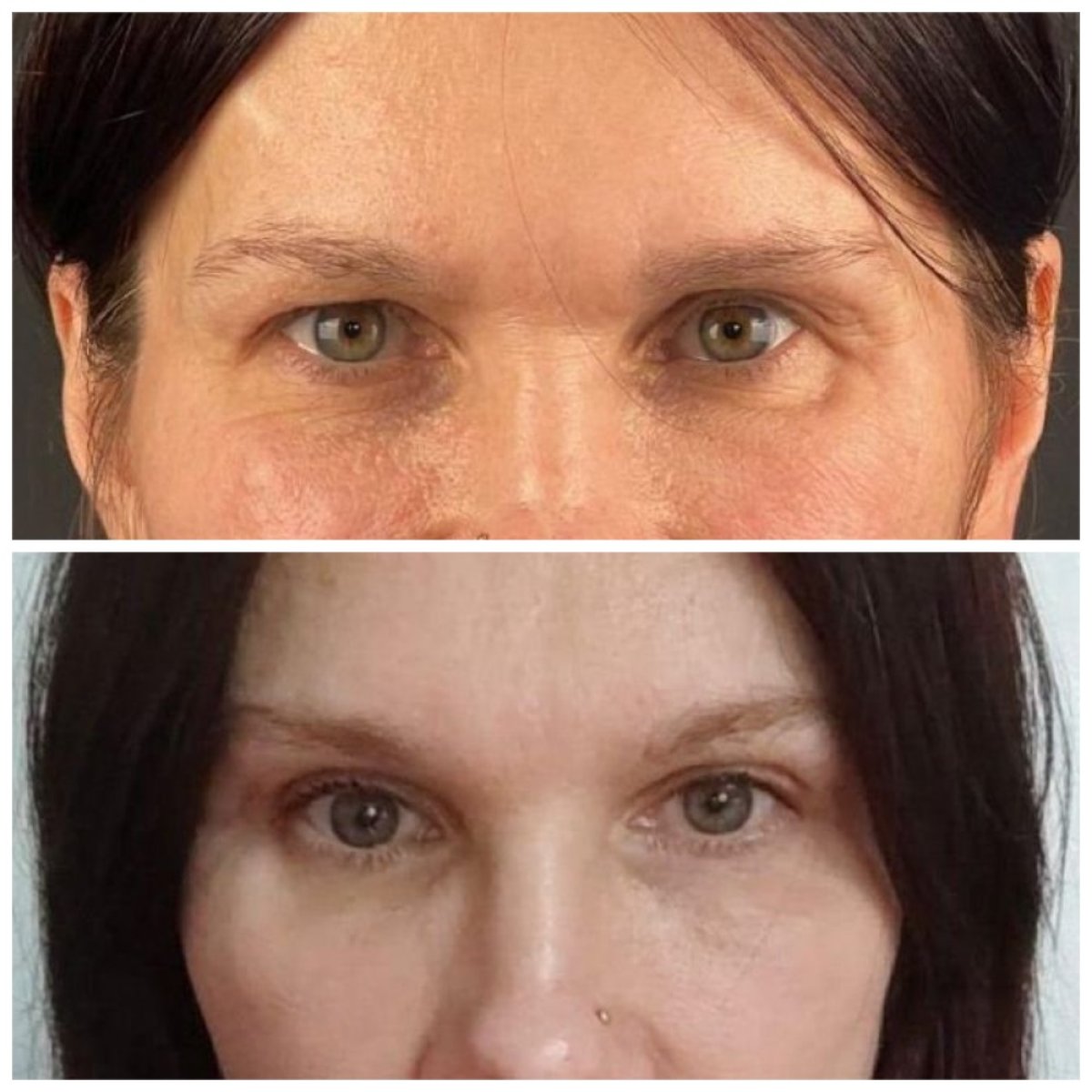 Before and after blepharoplasty results at Soraca Med, eyelid correction for youthful eyes