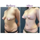 Before and after Tummy tuck photos by Dr. Derya Bingol