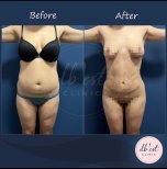Before and after Liposuction photos by Dr. Derya Bingol