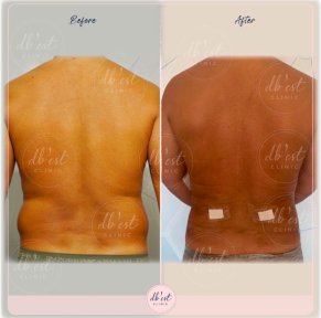 Lipedema Surgery with Vaser Technology - photo 6
