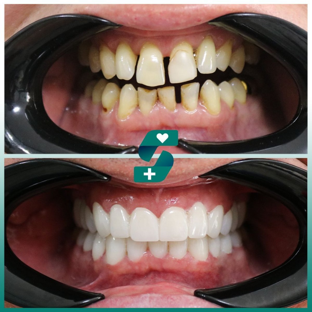 Before and after smile makeover at Soraca Med – dental veneers result, whiter aligned teeth