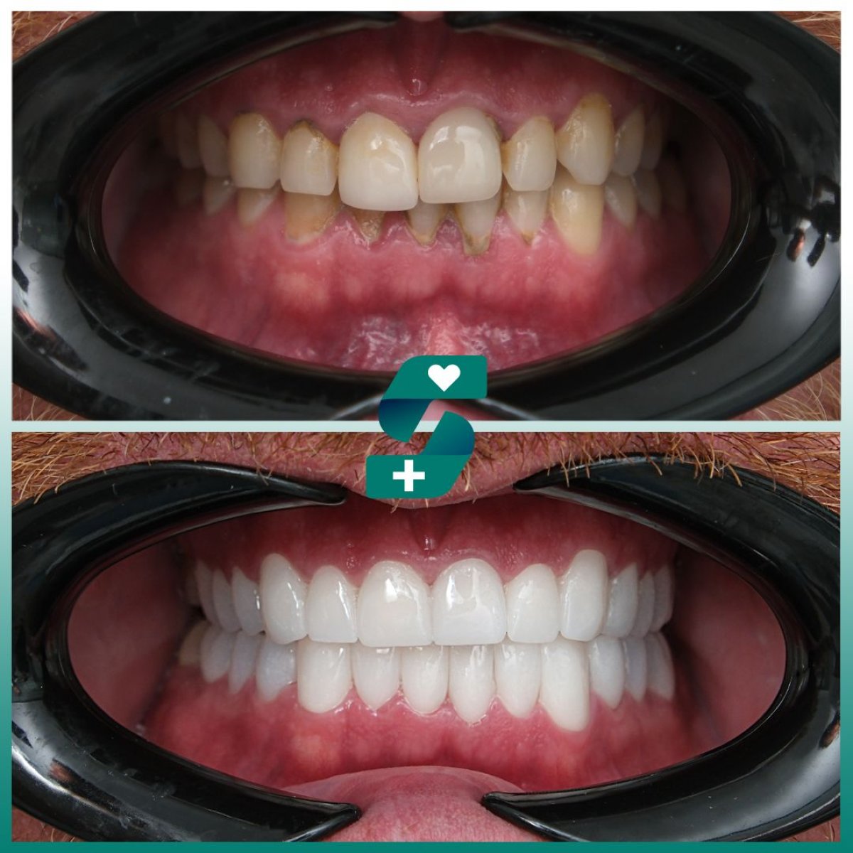 Before and after smile makeover at Soraca Med – dental veneers for whiter, aligned teeth result