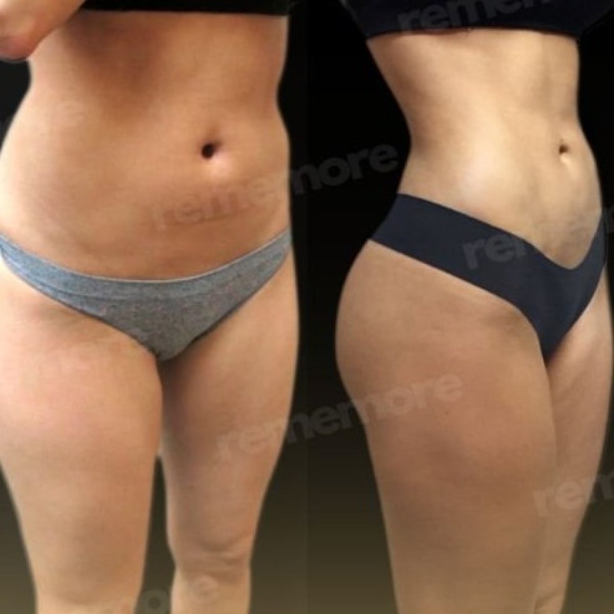 Before and after liposuction results at Memorial Şişli Hospital, improved body contour