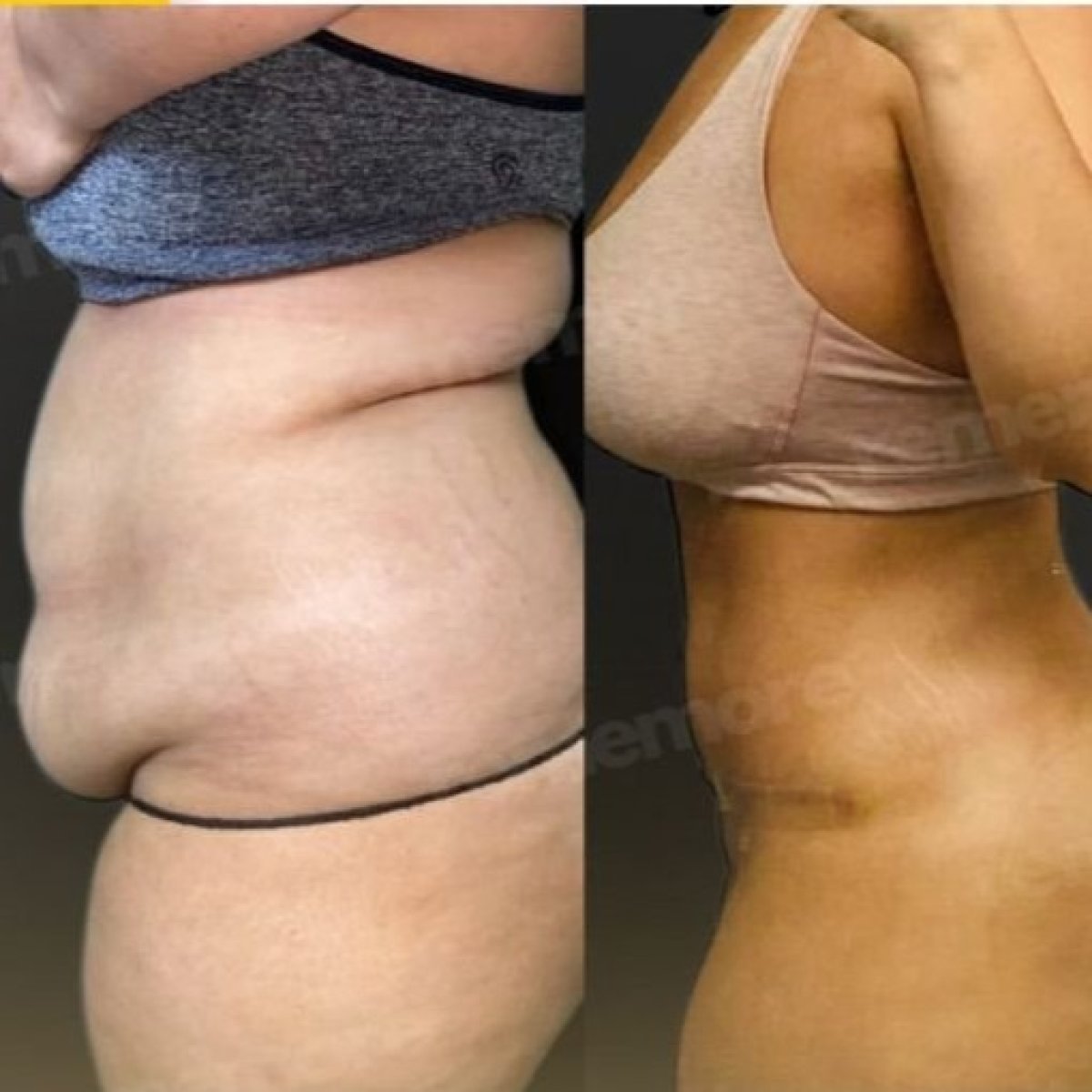 Vorher-nachher-Ergebnis 360°-Liposuktion bei Memorial Bahçelievler Hospital, Körperkontur