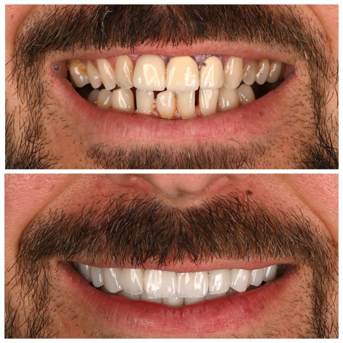 Before and after smile makeover at Soraca Med, improved teeth alignment and whitening result