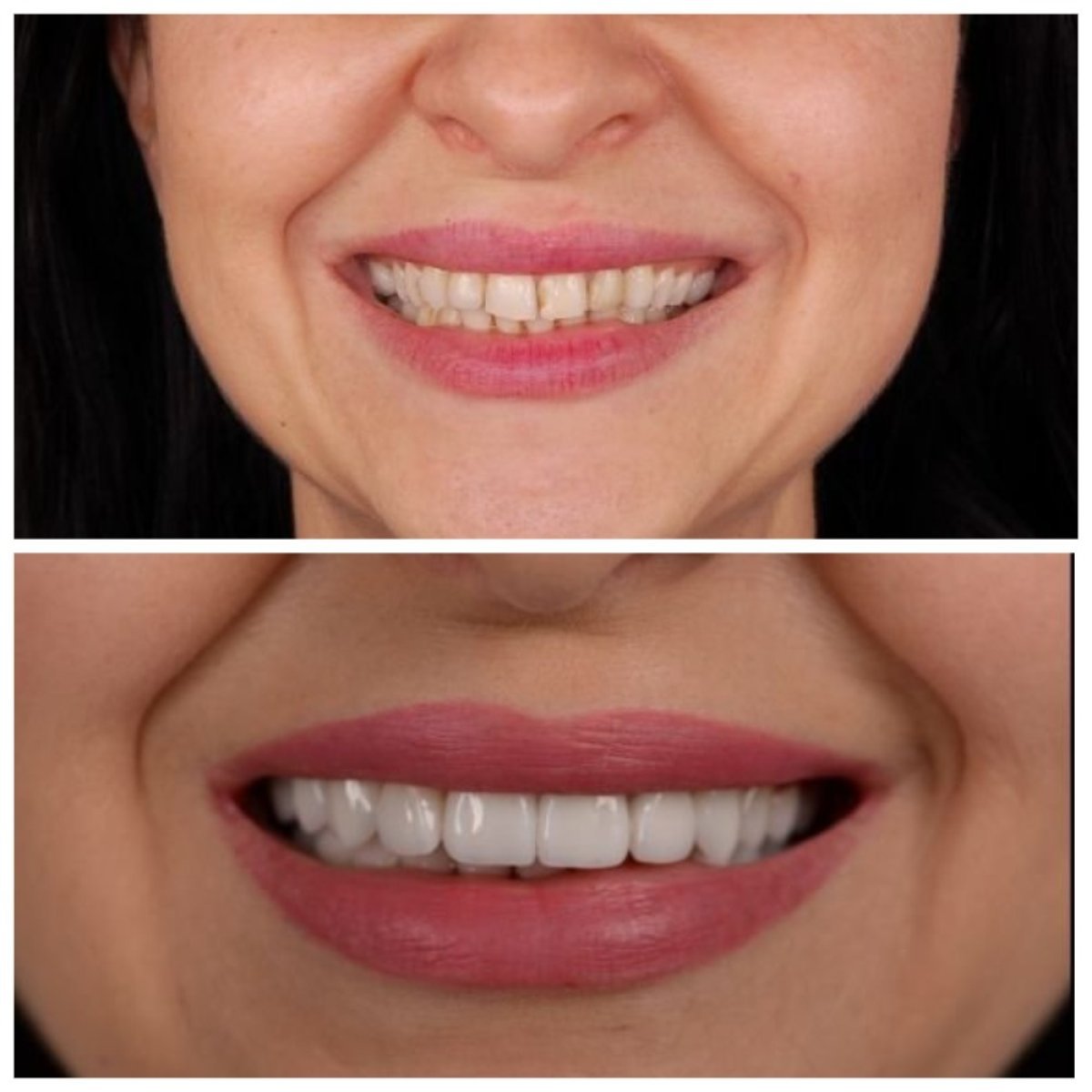 Результаты до и после Hollywood Smile с винирами в клинике RIKOTA Dental Clinic