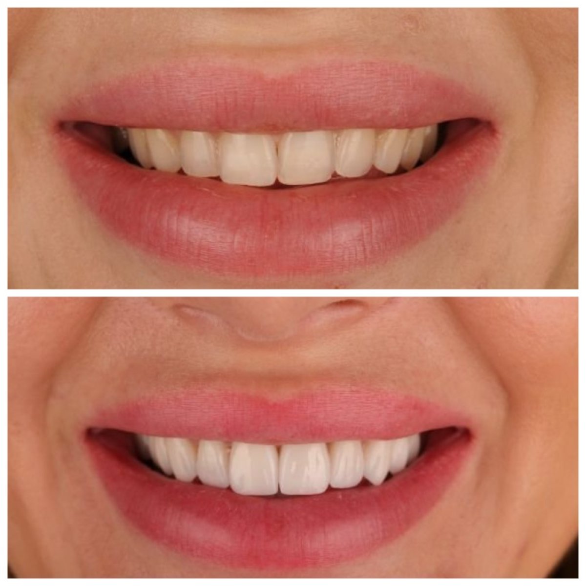 Before and after Hollywood Smile results at RIKOTA Dental Clinic with dental veneers