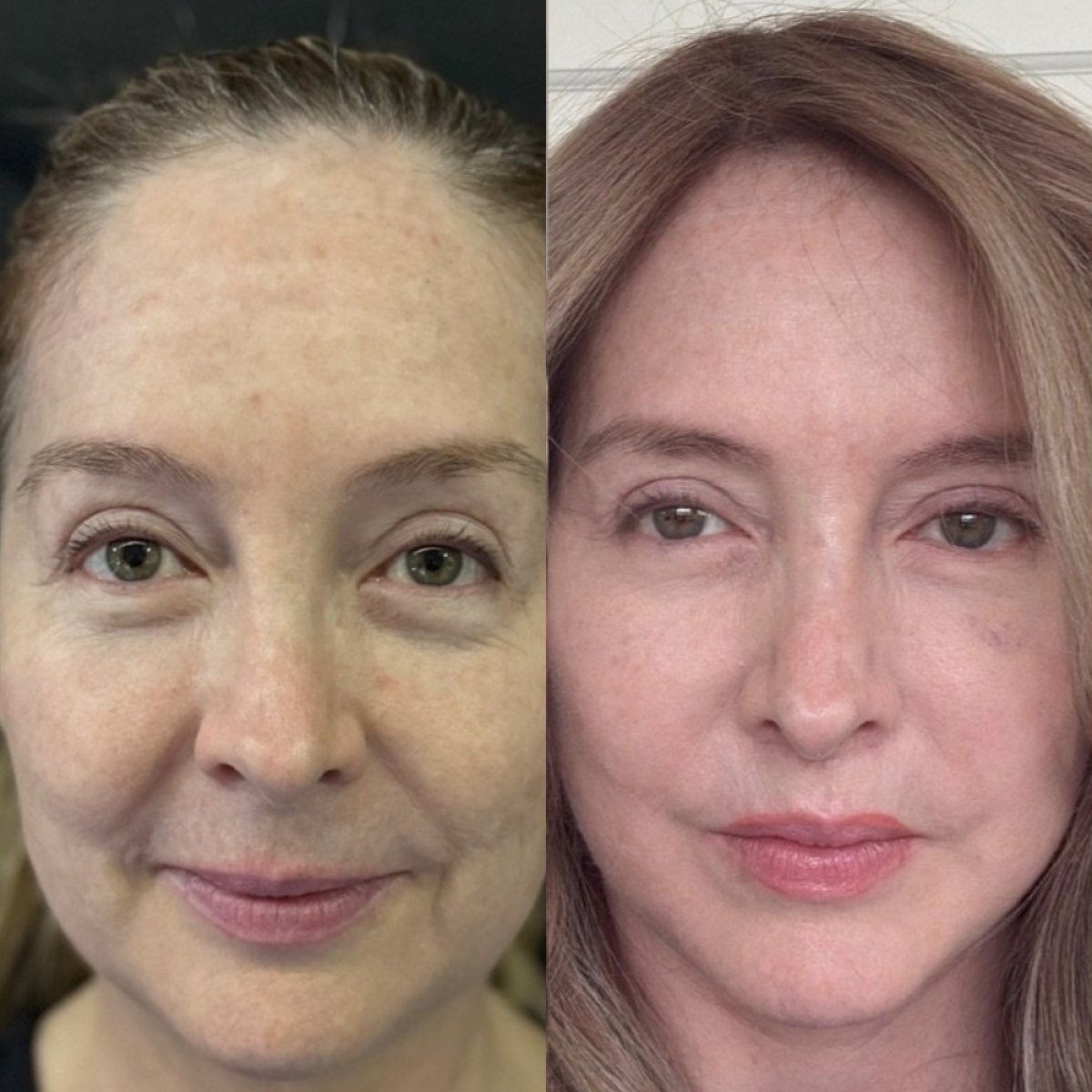 Resultados de blefaroplastia de párpado inferior antes y después en Marroquín & Sandoval