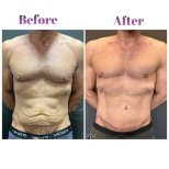 Before and after Tummy tuck photos by Dr. Derya Bingol