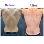 Before and after Liposuction photos by Dr. Derya Bingol