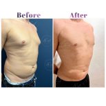 Before and after Liposuction photos by Dr. Derya Bingol