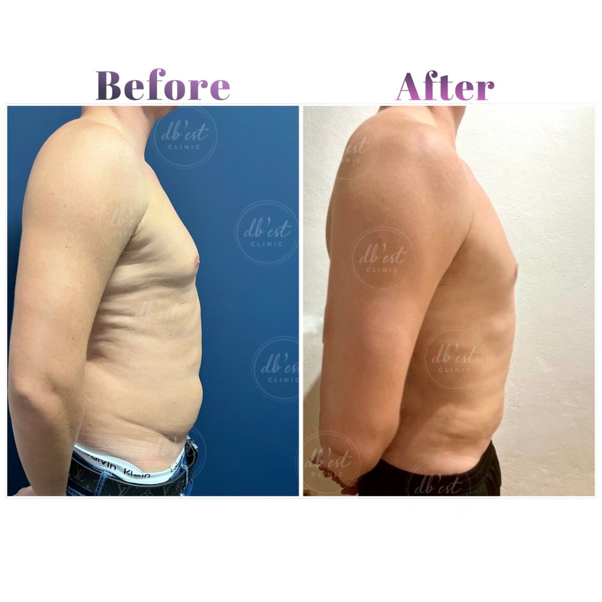 Resultados de Vaser liposucción antes y después en Db'est Clinic – mejor contorno masculino