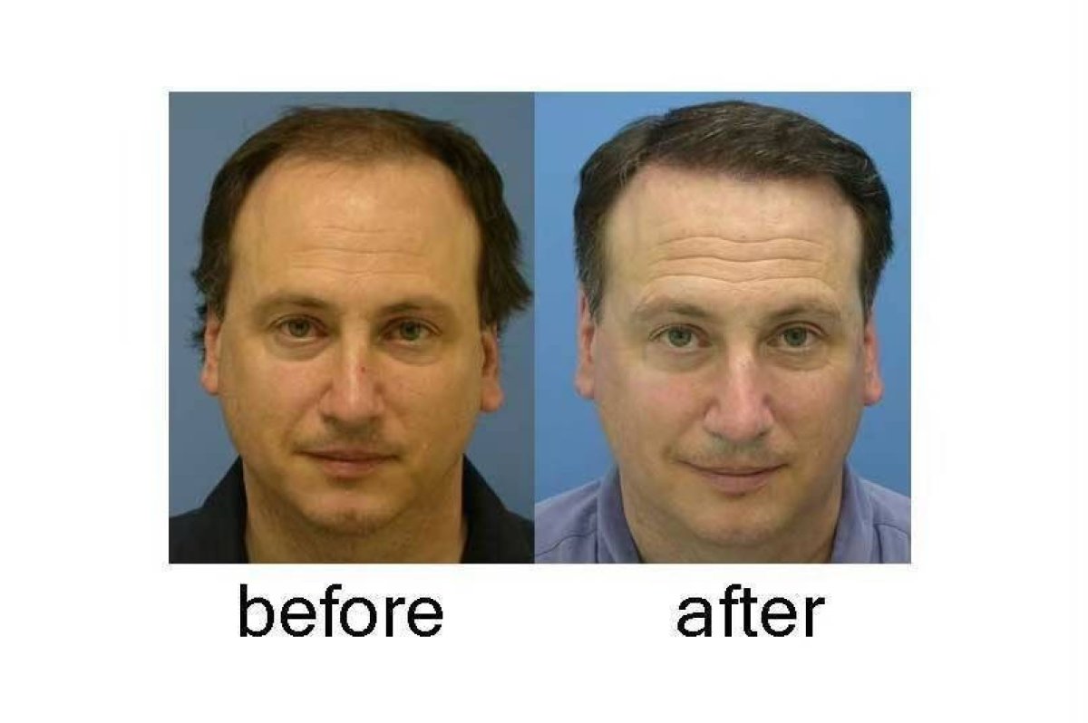Before and after DHI hair transplant results at ID Clinic Bangkok, restored hairline in male patient