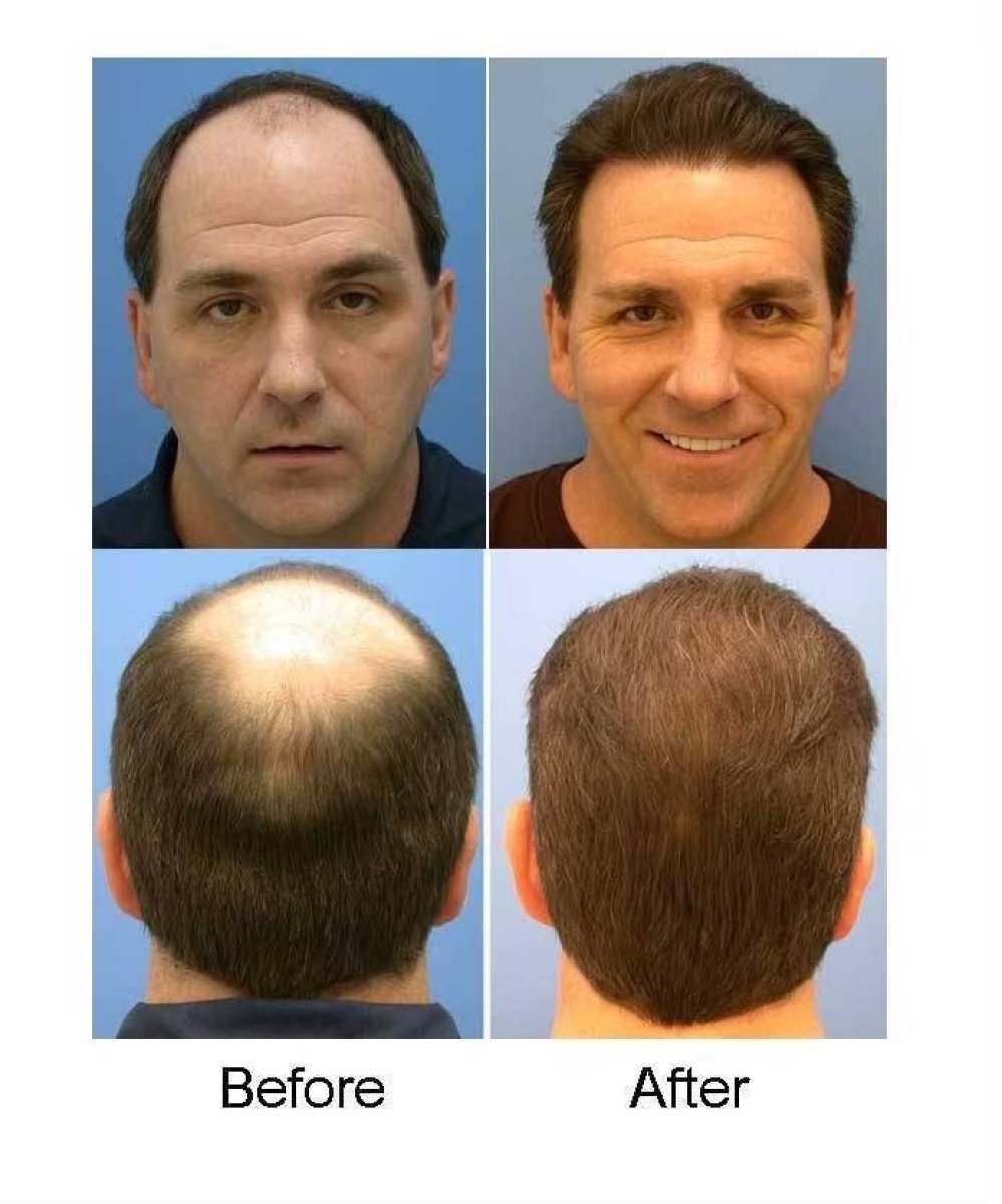 Before and after DHI hair transplant results at ID Clinic Bangkok – restored hairline and density