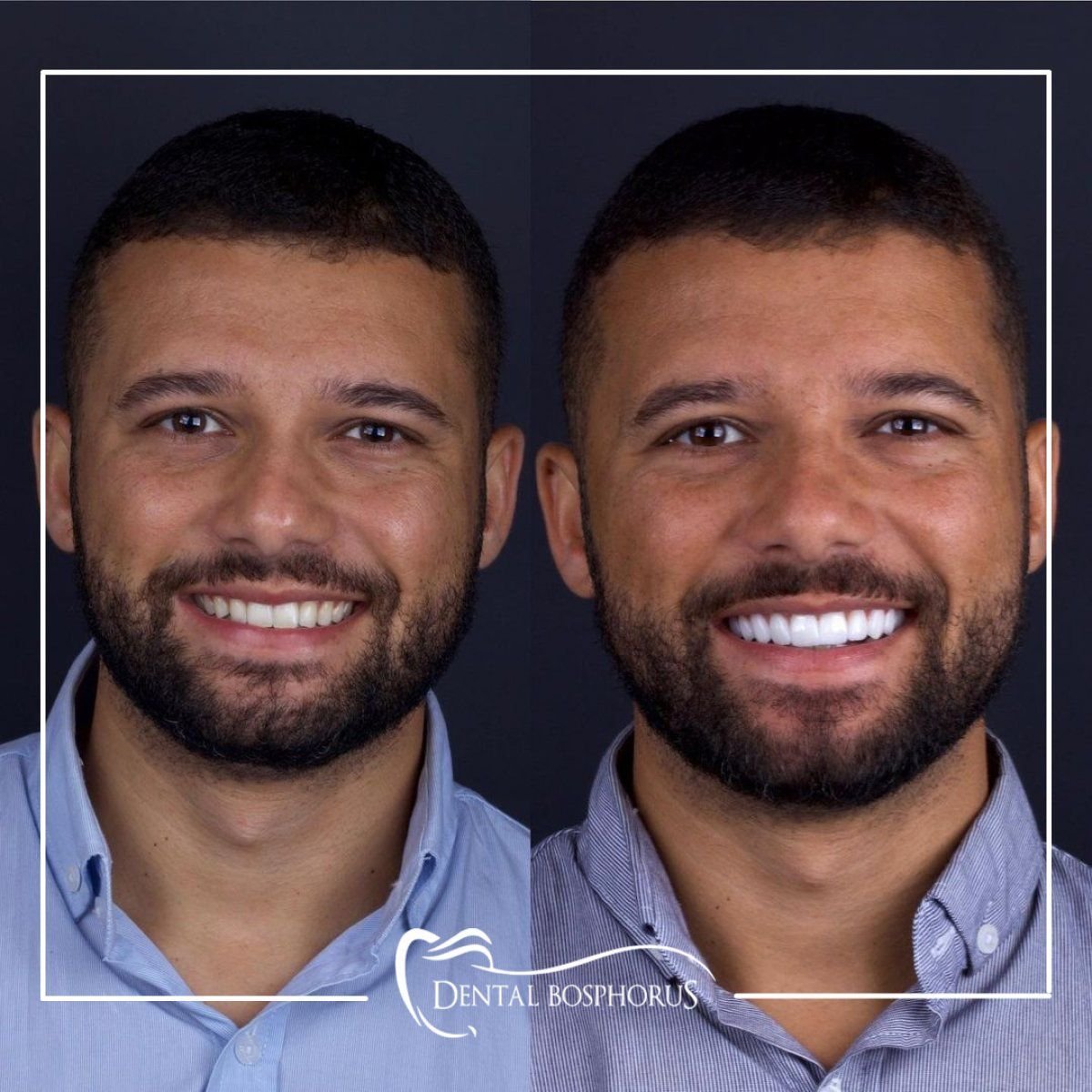 نتيجة قبل وبعد عدسات إيماكس في Dental Bosphorus، ابتسامة محسنة