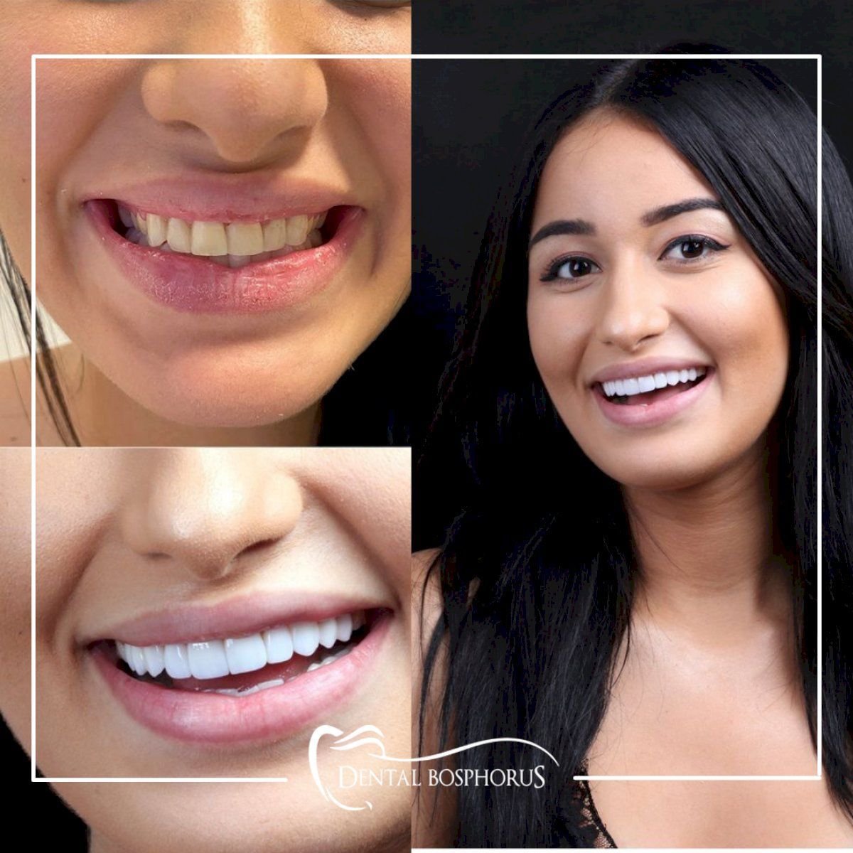 Before and after Emax veneers at Dental Bosphorus, smile makeover with natural results