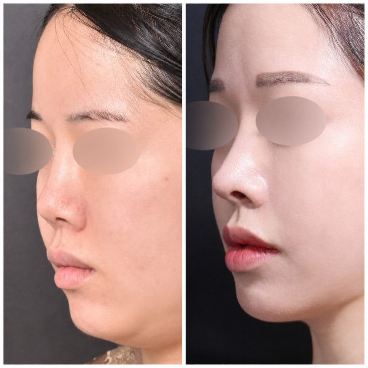 قبل وبعد عملية تجميل الأنف في VG Plastic Surgery، نتيجة تحديد شكل الأنف