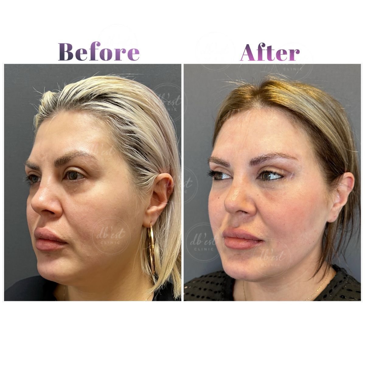Résultats avant/après mini lifting du visage à Db'est Clinic – rajeunissement visible