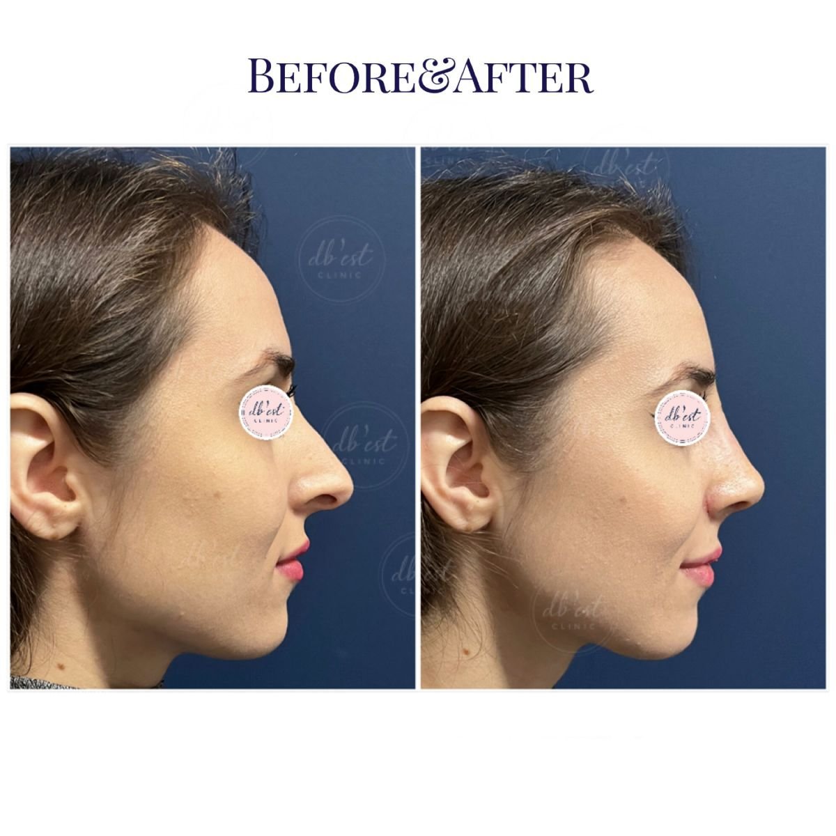 Before and after rhinoplasty results at Db'est Clinic, nose reshaping with natural profile