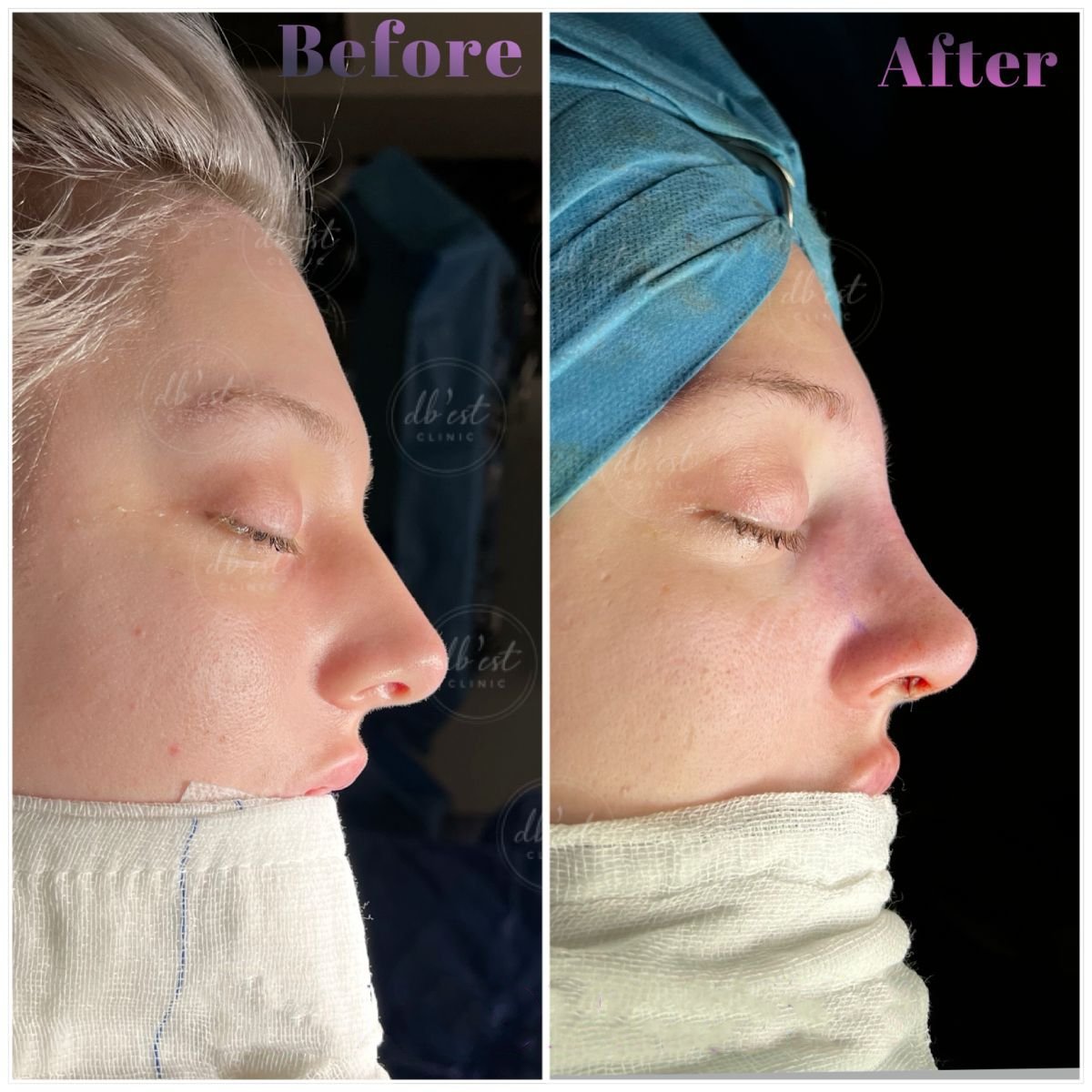 Resultados de rinoplastia antes y después en Db'est Clinic, mejora de forma y perfil nasal