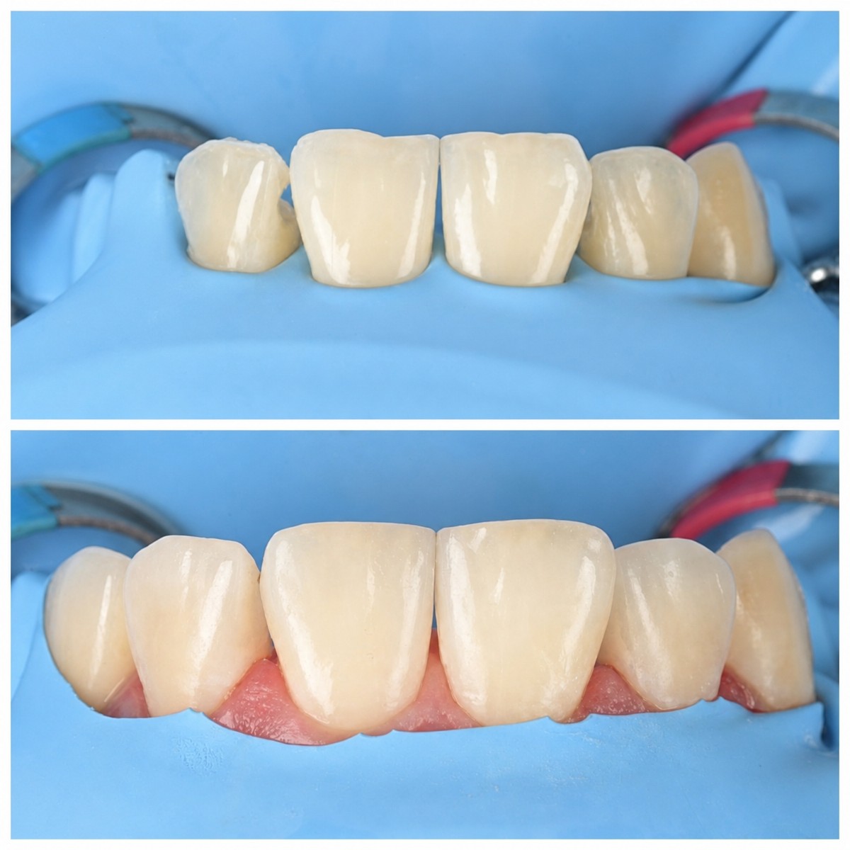 Résultats avant/après du bonding dentaire pour les dents de devant à la clinique RIKOTA