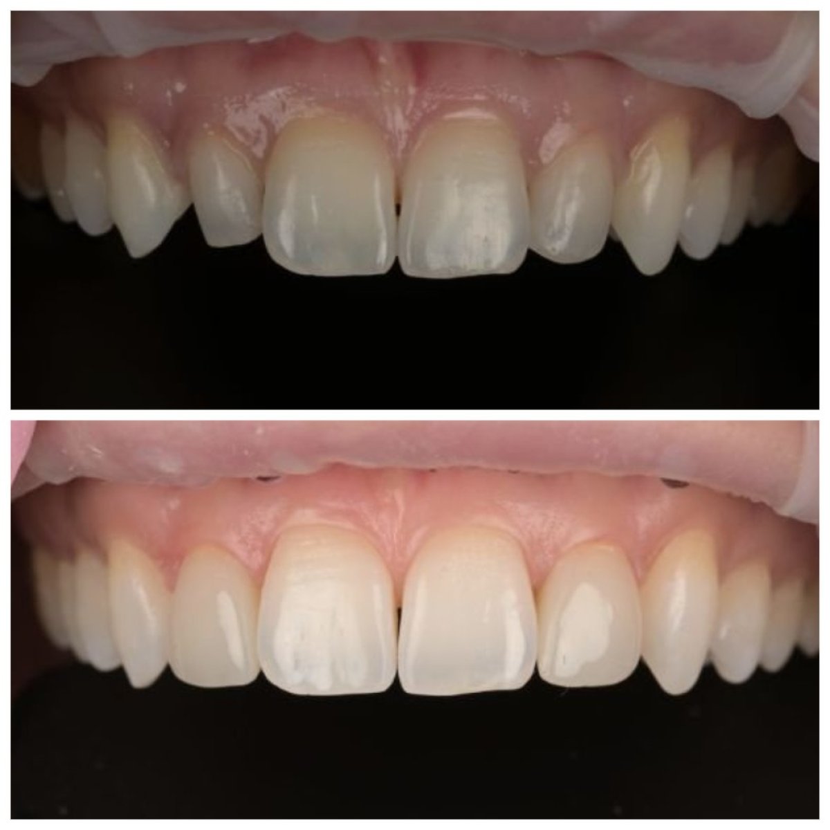 Before and after dental bonding results at RIKOTA Dental Clinic for improved front teeth