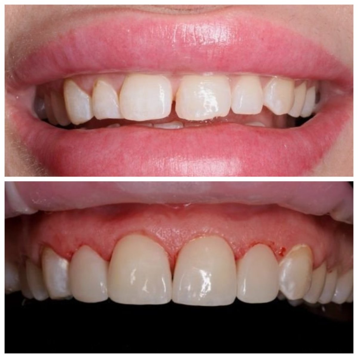 Resultados de antes y después de bonding dental en RIKOTA Dental Clinic para mejorar la sonrisa
