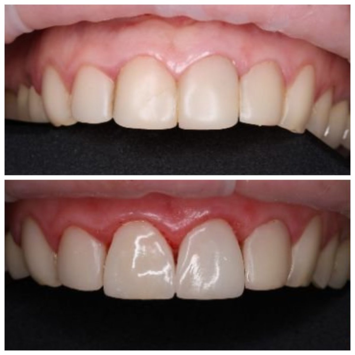 Resultados de antes y después de bonding dental en RIKOTA Dental Clinic para dientes frontales