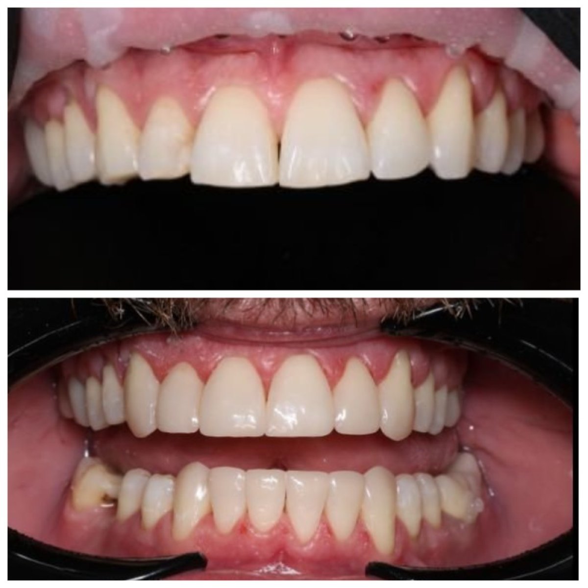 Resultados antes y después de bonding dental en RIKOTA Dental Clinic, mejor forma y color dental
