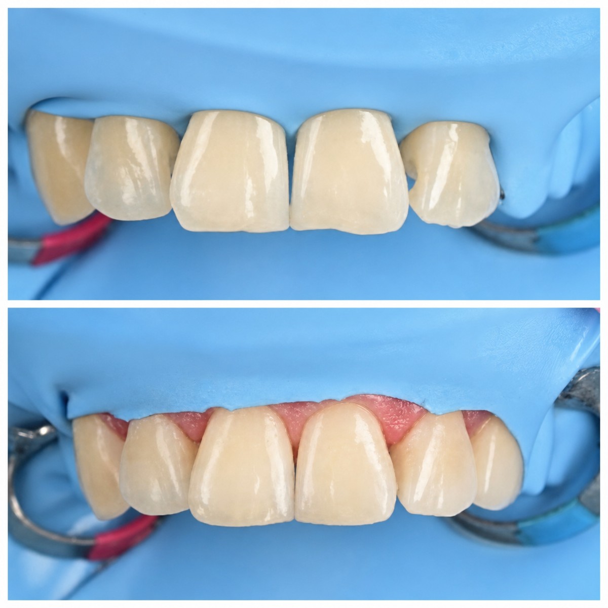 نتائج قبل وبعد ترميم الأسنان الأمامية بتقنية البوندينغ في عيادة RIKOTA Dental Clinic