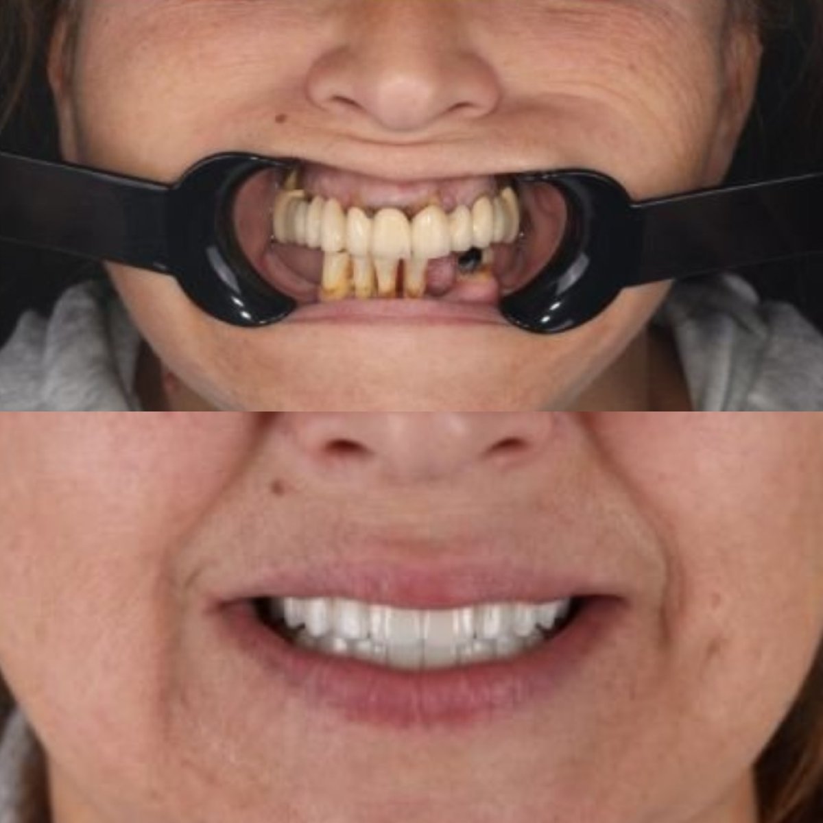 Résultats avant et après prothèse dentaire à la clinique RIKOTA, sourire amélioré