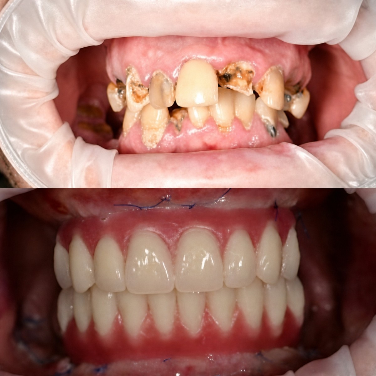 نتائج قبل وبعد طقم الأسنان في RIKOTA Dental Clinic – ابتسامة وأسنان صحية مستعادة