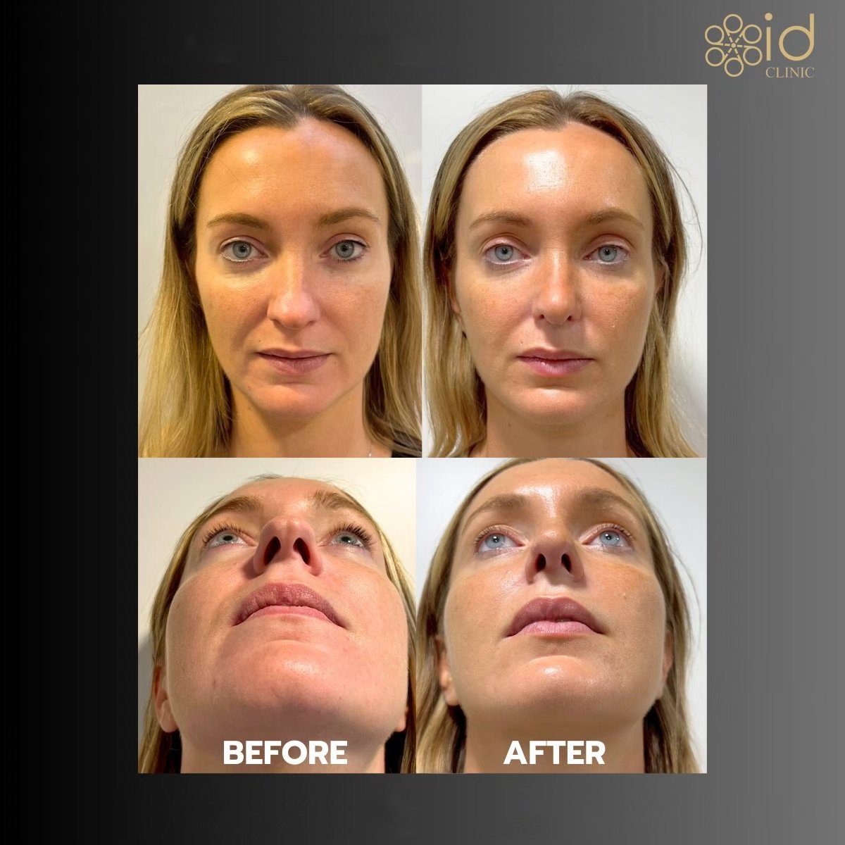 Before and after rhinoplasty results at ID Clinic Bangkok, nose reshaping with natural look