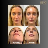 صور قبل وبعد جراحة الأنف (انظر عملية تجميل الأنف) للدكتور Dr Phatcharasak Kraisornphongsakul Md