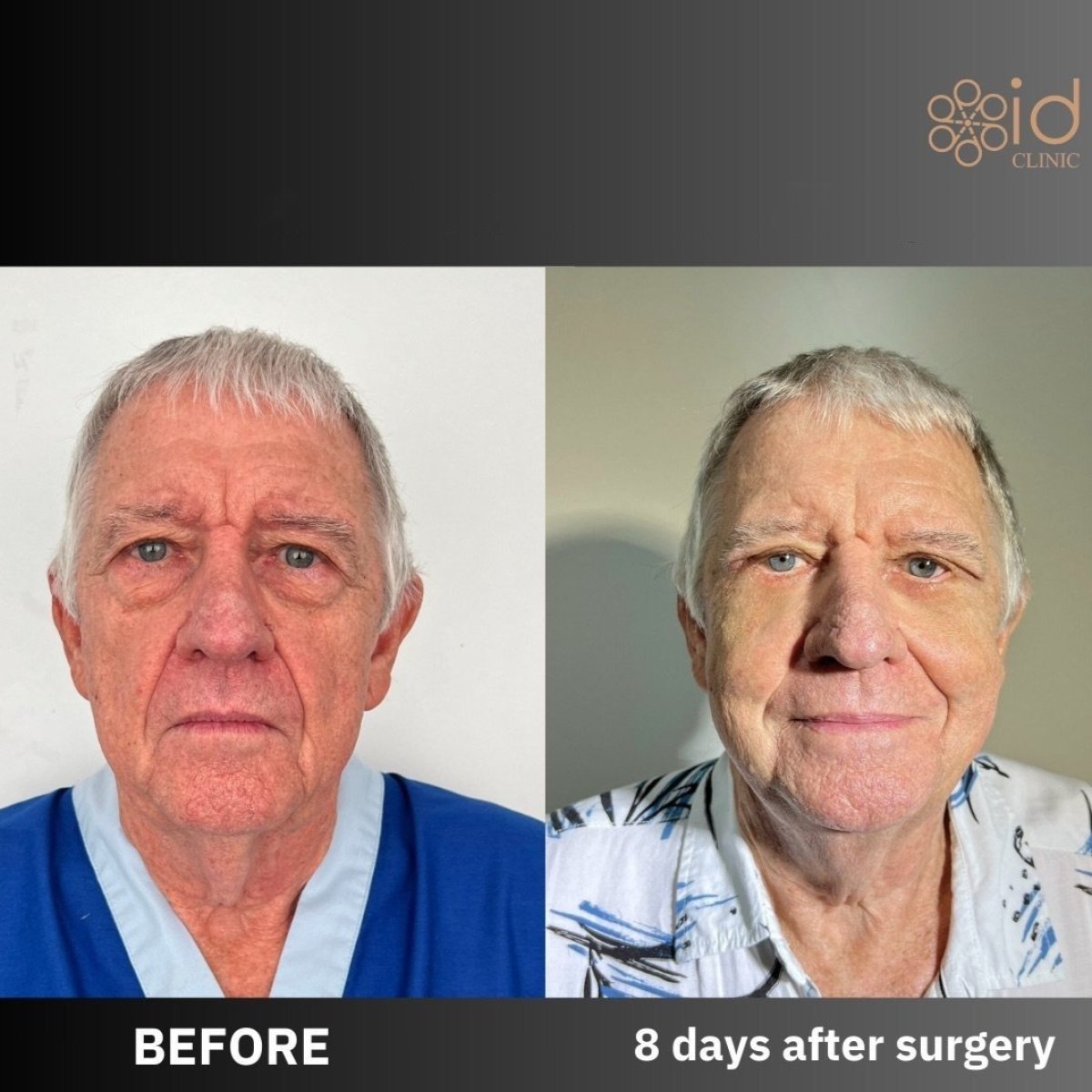 Before and after upper eyelid surgery results at ID Clinic Bangkok, 8 days post-procedure