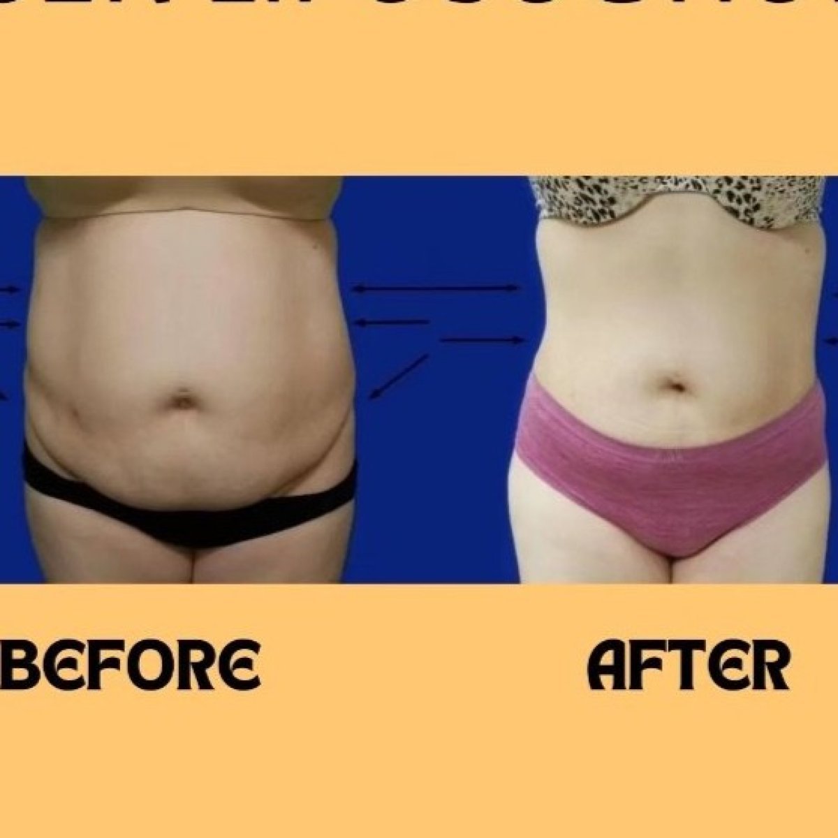 Before and after BodyTite body contouring results at ID Clinic Bangkok, abdomen slimming