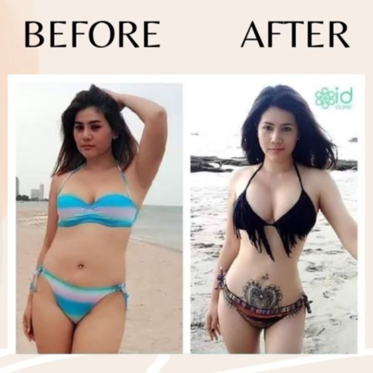 Before and after BodyTite body contouring results at ID Clinic Bangkok, improved body shape