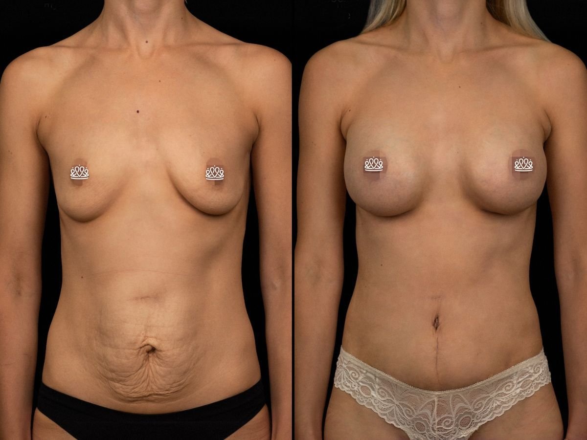 Résultats avant et après abdominoplastie et augmentation mammaire à la Vidnova Clinic