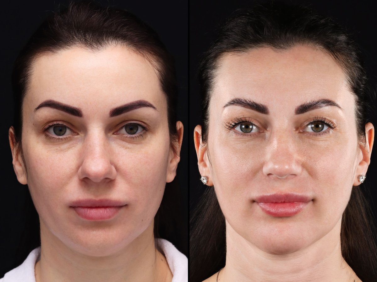 Résultats avant/après lifting deep plane à la Vidnova Clinic – rajeunissement du visage