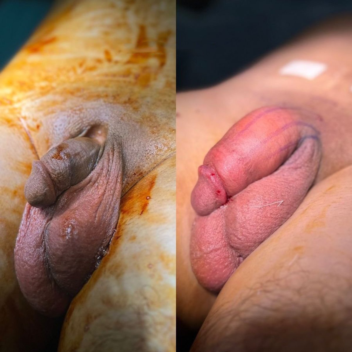 Resultados antes y después de aumento de pene en Uroaesthetic – mejora visible del tamaño