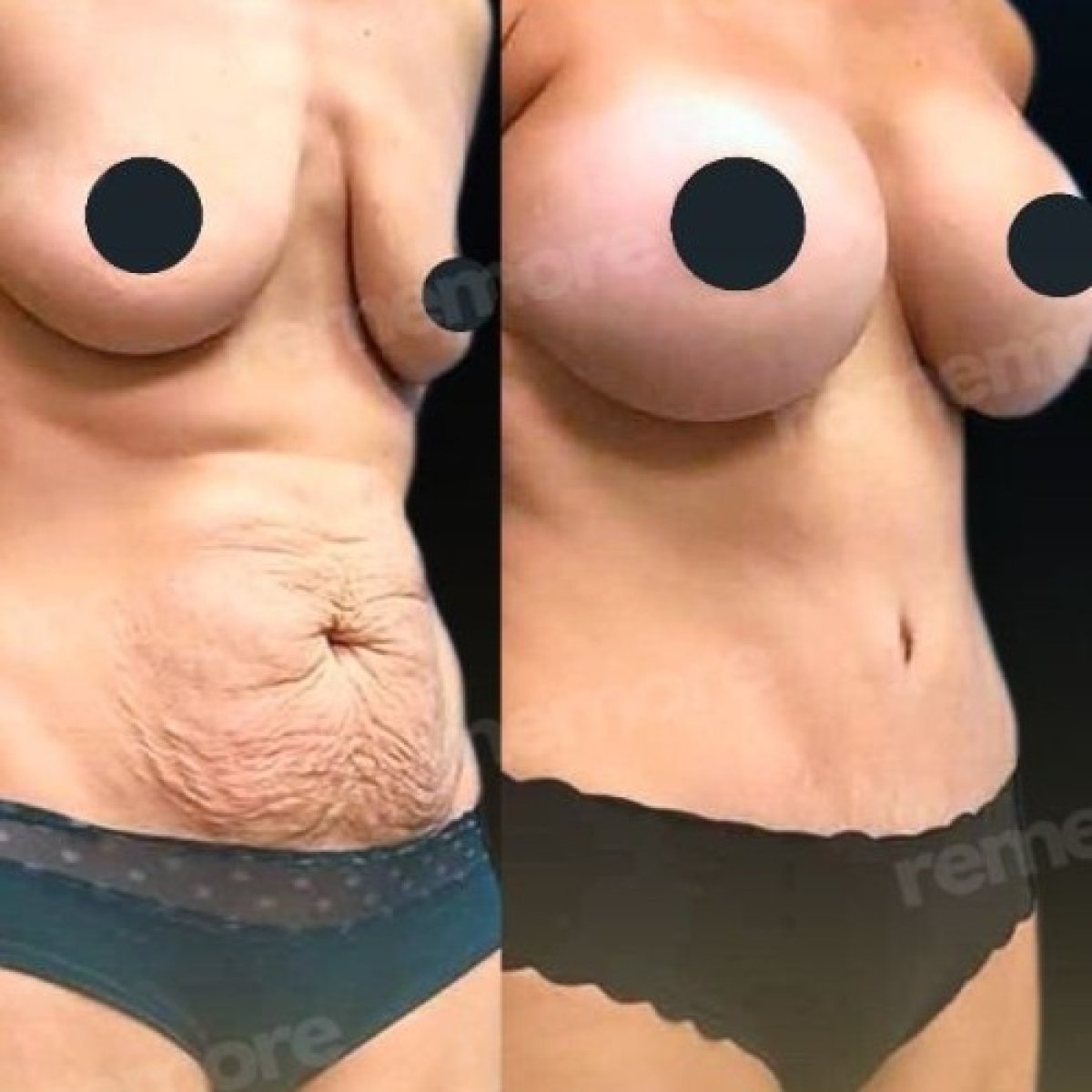 Resultados antes y después de mastopexia y abdominoplastia en Memorial Göztepe Hospital