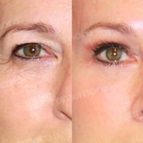 Blepharoplasty for Refreshed & Youthful Eyes — 5★ Hotel & VIP Transfer - photo 4