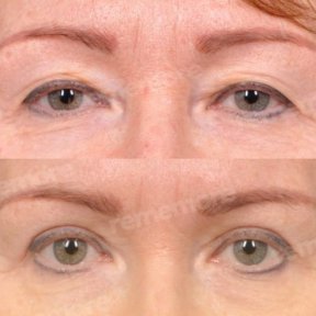 Blepharoplasty for Refreshed & Youthful Eyes — 5★ Hotel & VIP Transfer - photo 5