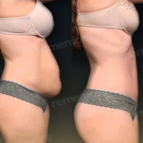 360 liposuction+tummy tuck - photo 5