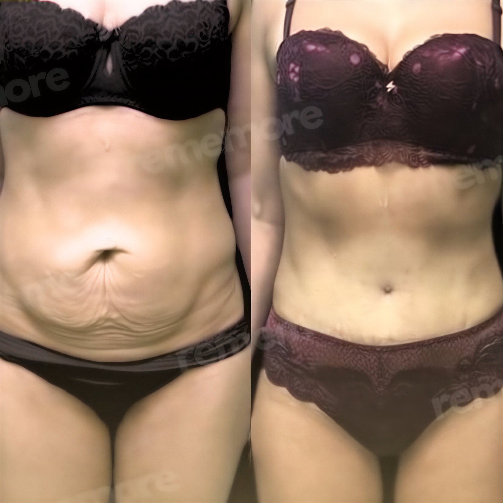 Resultados antes y después de abdominoplastia y liposucción en Memorial Göztepe Hospital