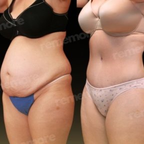 360 liposuction+tummy tuck - photo 6