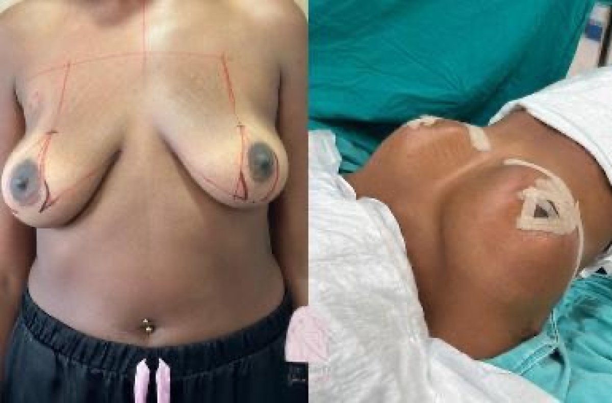 قبل وبعد تكبير الثدي في Dr. MED – رفع واضح وتحسين شكل الثدي