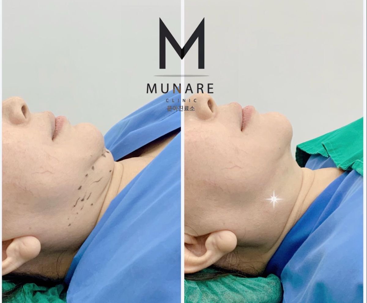 نتائج شفط دهون الذقن قبل وبعد في عيادة Munare – تحسين تحديد الفك