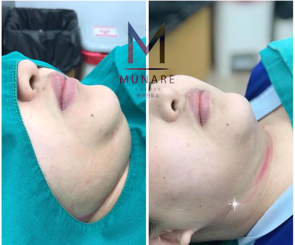 نتائج شفط دهون الذقن قبل وبعد في عيادة Munare – تحسين تحديد الفك